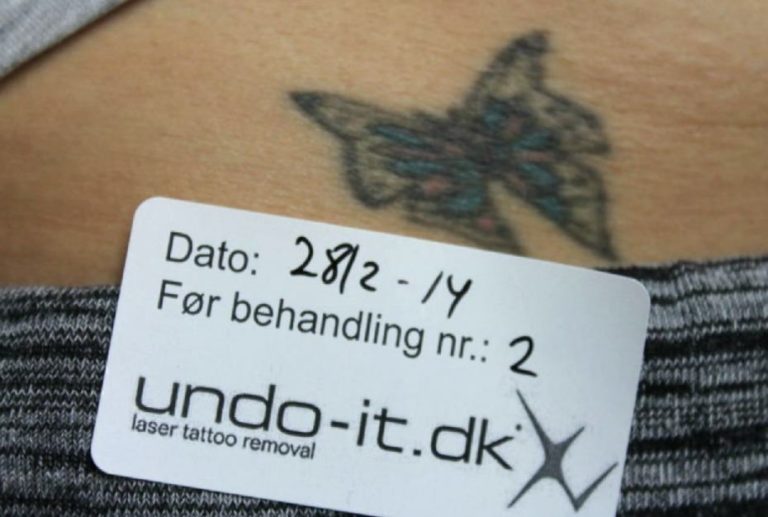 Fjernelse af tatovering 2